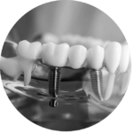 Dental Implants Bondi Junction Sydney